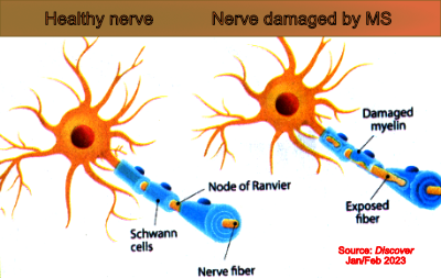 Healthy & unhealthy nerve